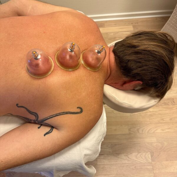 Cupping